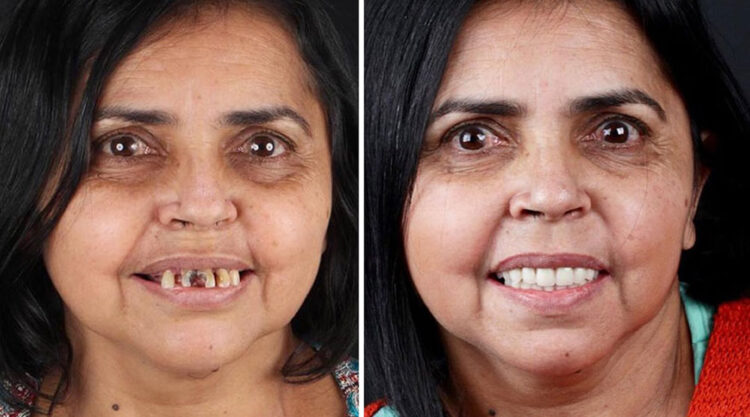Brazilian Dentist Felipe Rossi Treat The Teeth Of Poor People: Here Are The 30 Photos Of Transformations