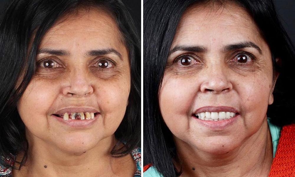 Brazilian Dentist Felipe Rossi Treat The Teeth Of Poor People: Here Are The 30 Photos Of Transformations