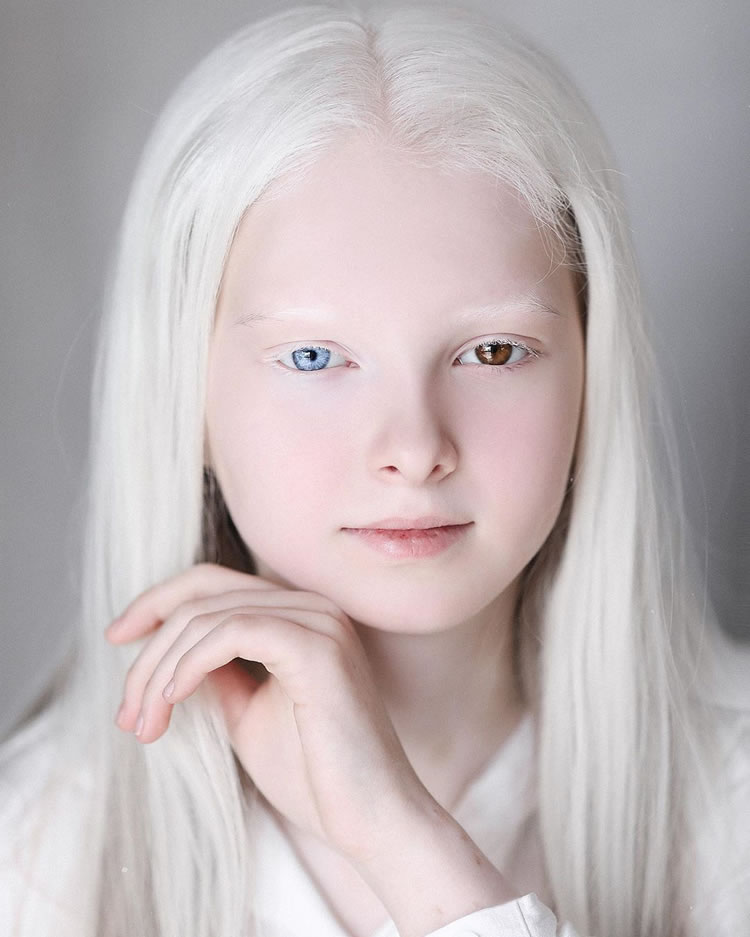 Beautiful Girl With Albinism And Heterochromia
