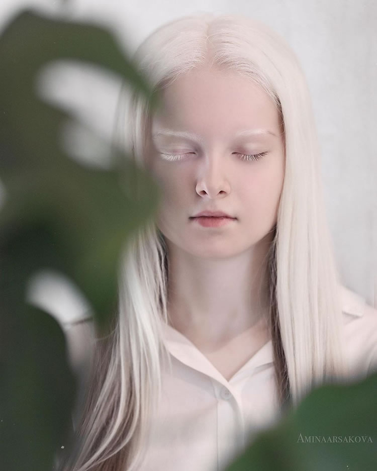 Beautiful Girl With Albinism And Heterochromia