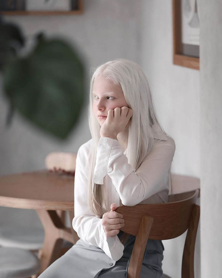 Beautiful Girl With Albinism And Heterochromia