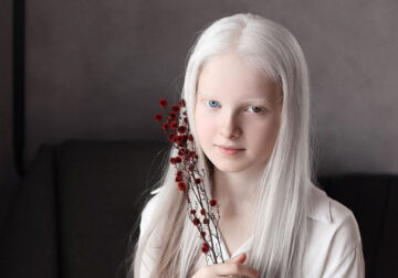 Beautiful Girl With Albinism And Heterochromia
