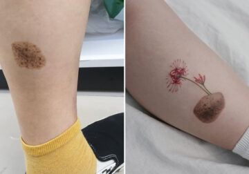 Cover-up Tattoos Scars and Birthmark