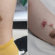Cover-up Tattoos Scars and Birthmark