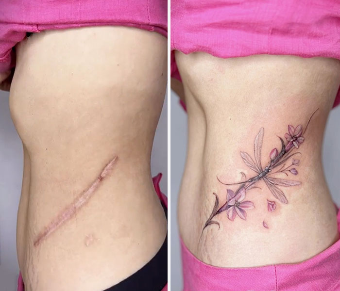 scar coverup  Tattoos to cover scars, Cover tattoo, Scar tattoo