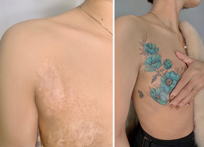 Scars Cover Up Tattoos By Tran Thi Bich Ngoc