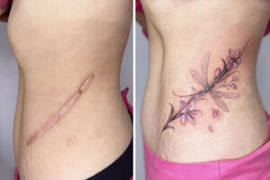 25 Scar Tattoos That Transform Old Wounds Into Beautiful Works Of