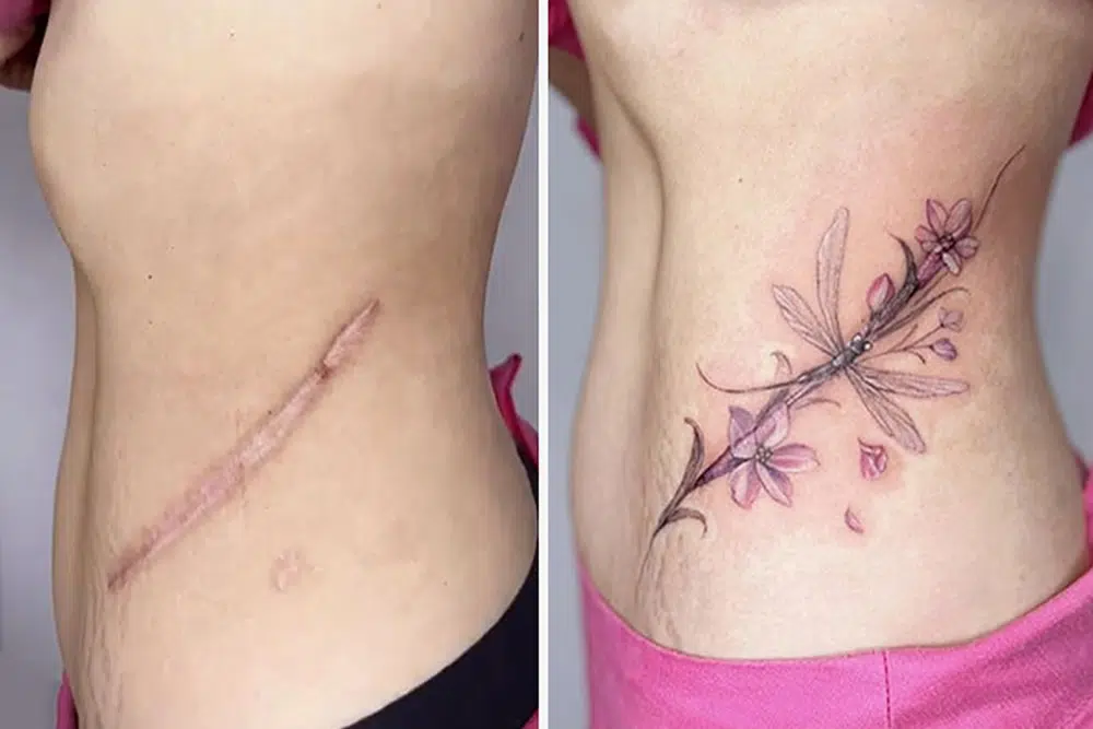 Scars Cover Up Tattoos By Tran Thi Bich Ngoc