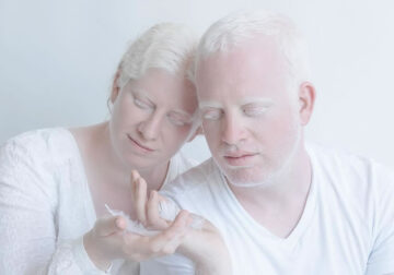 The Beauty Of Albino People