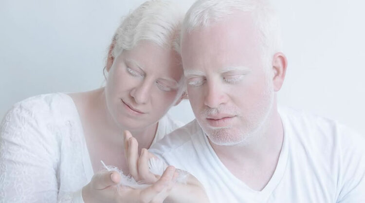 The Beauty Of Albino People