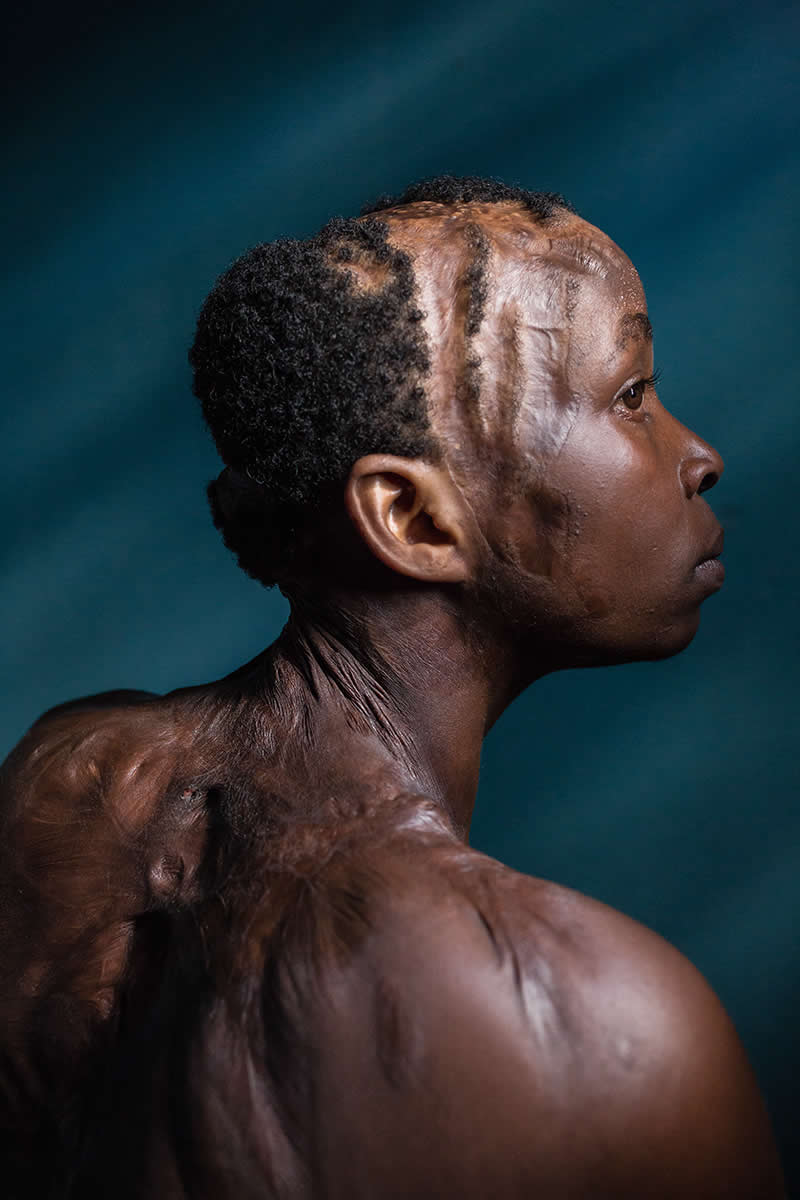 2025 Chromatic Awards - Portrait, 1st Place winner: Lynette, acid attack survivor by Erberto Zani, Italy