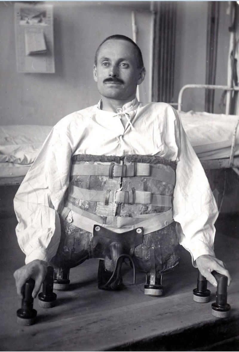 German soldier Dominikus M&uuml;ller in a hospital, 1917, after losing his entire lower body (on the Western Front). - Rare Historical Vintage Photos