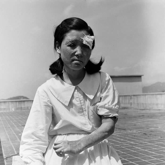 A survivor of the atomic bombing of Hiroshima photographed two years after the attack, Hiroshima, Japan, 1947.