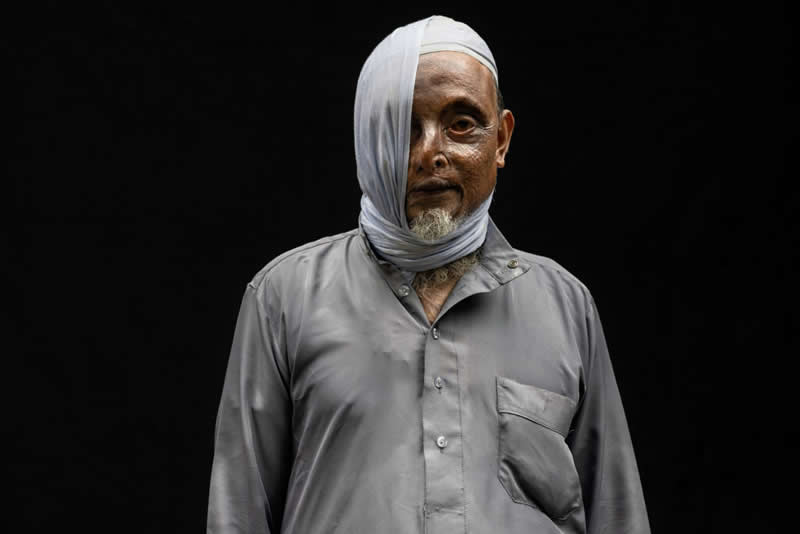 Documentary - Winner: Acid attack Survivors by Mohammed Muhtasib, Saudi Arabia - 12Awards Photography Competition Winners